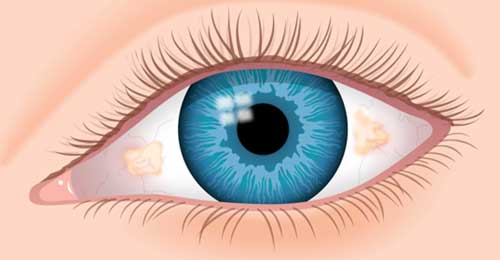 Lesión ocular benigna, elevada y amarillenta